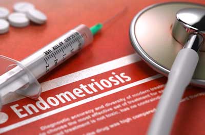 hysterectomy for endometriosis
